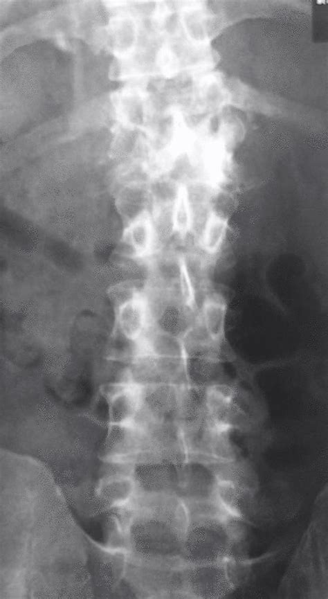 pott's disease x ray findings